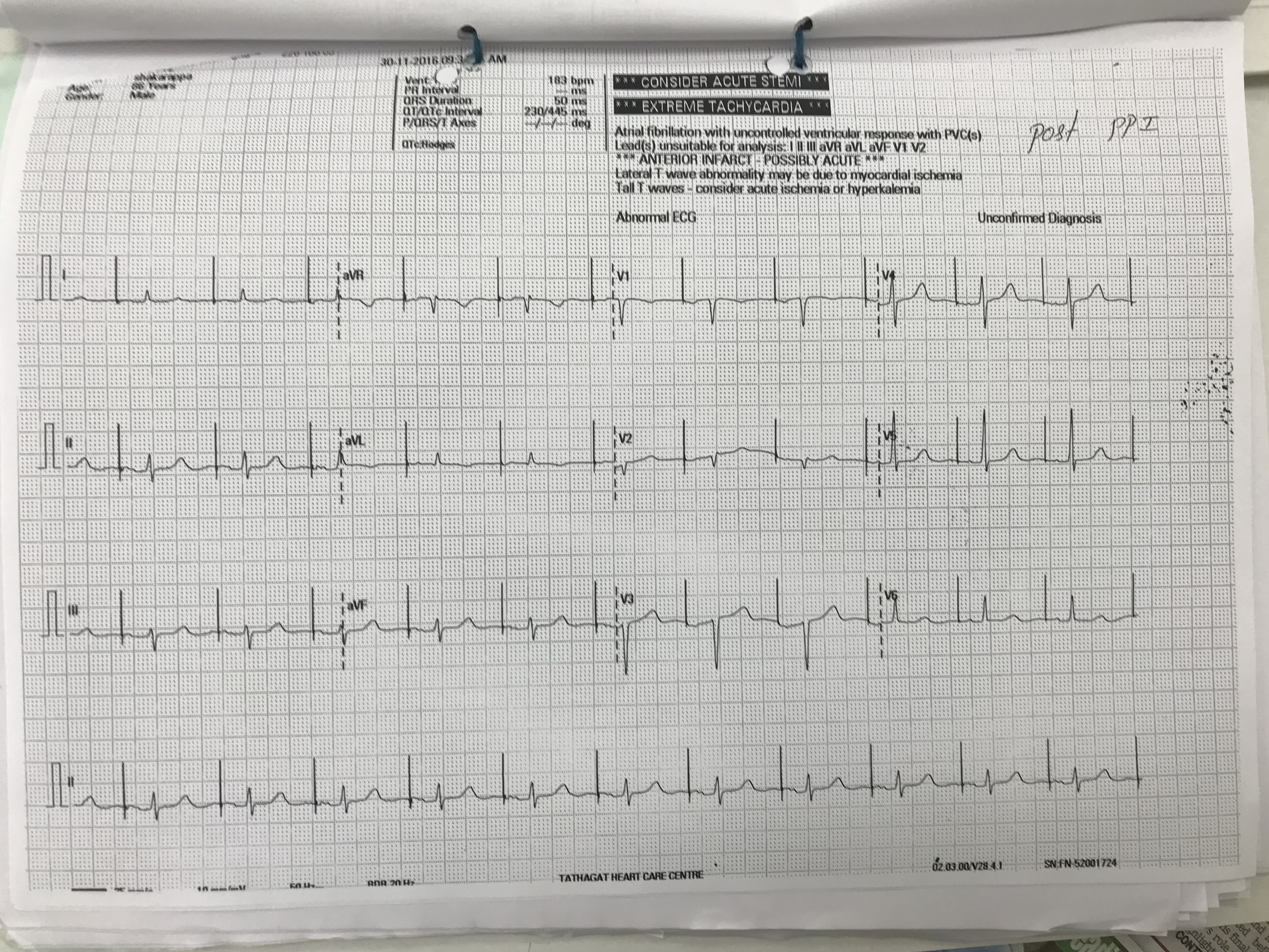 Case Of Sinus Bradycardia In 86 Year Old Patient